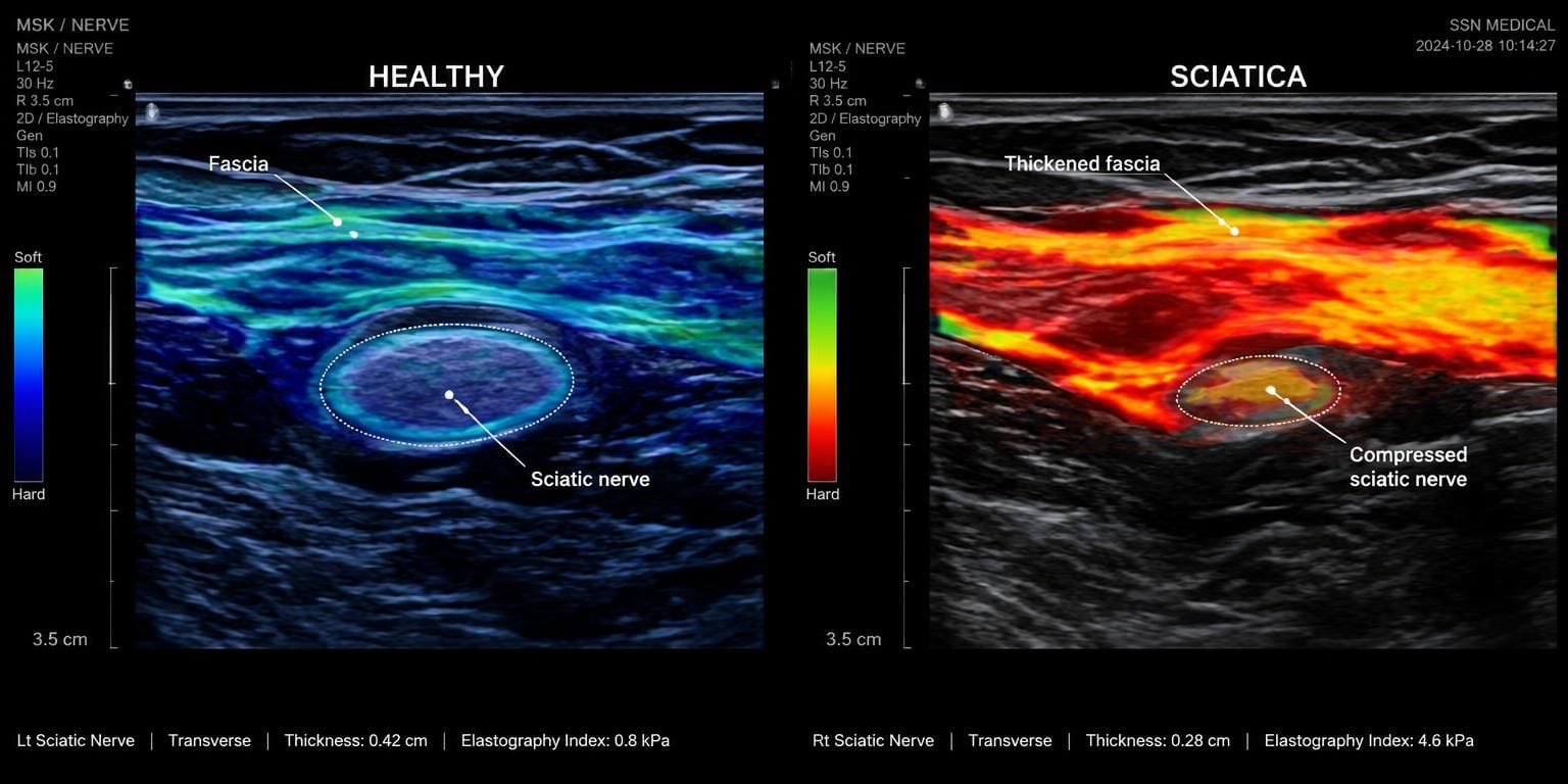 Ultrasound sonoelastography scan comparing healthy gluteal fascia versus densified fascial clamp on sciatic nerve